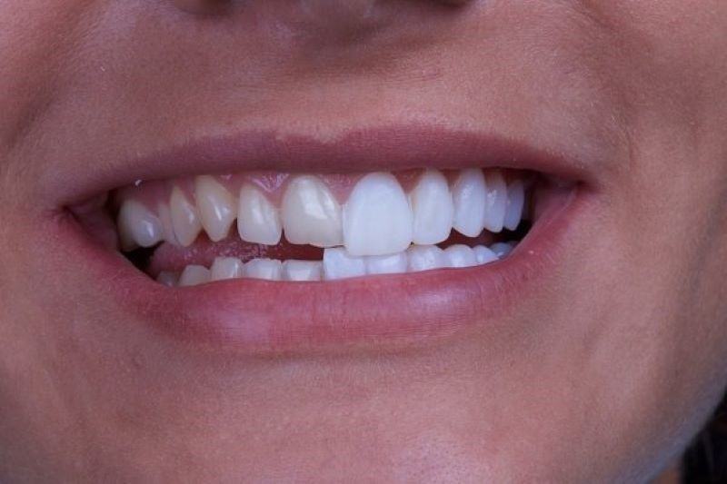 Chức năng ăn nhai và thẩm mỹ được cải thiện sau khi bọc sứ cho răng hô 