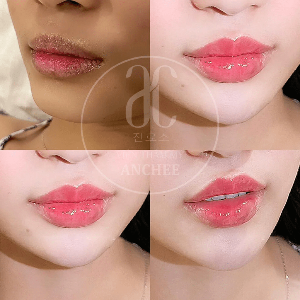 các dịch vụ chăm sóc môi tại anchee clinic