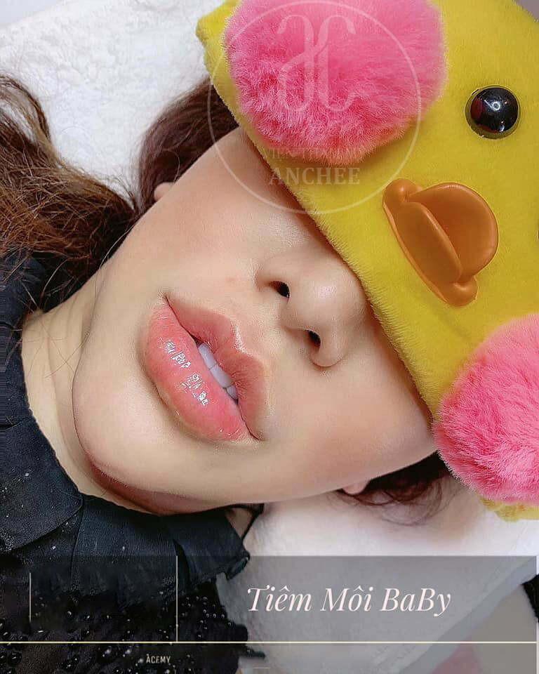 Anchee Clinic - Địa chỉ khử thâm môi bằng laser an toàn, cho môi hồng hào tự nhiên