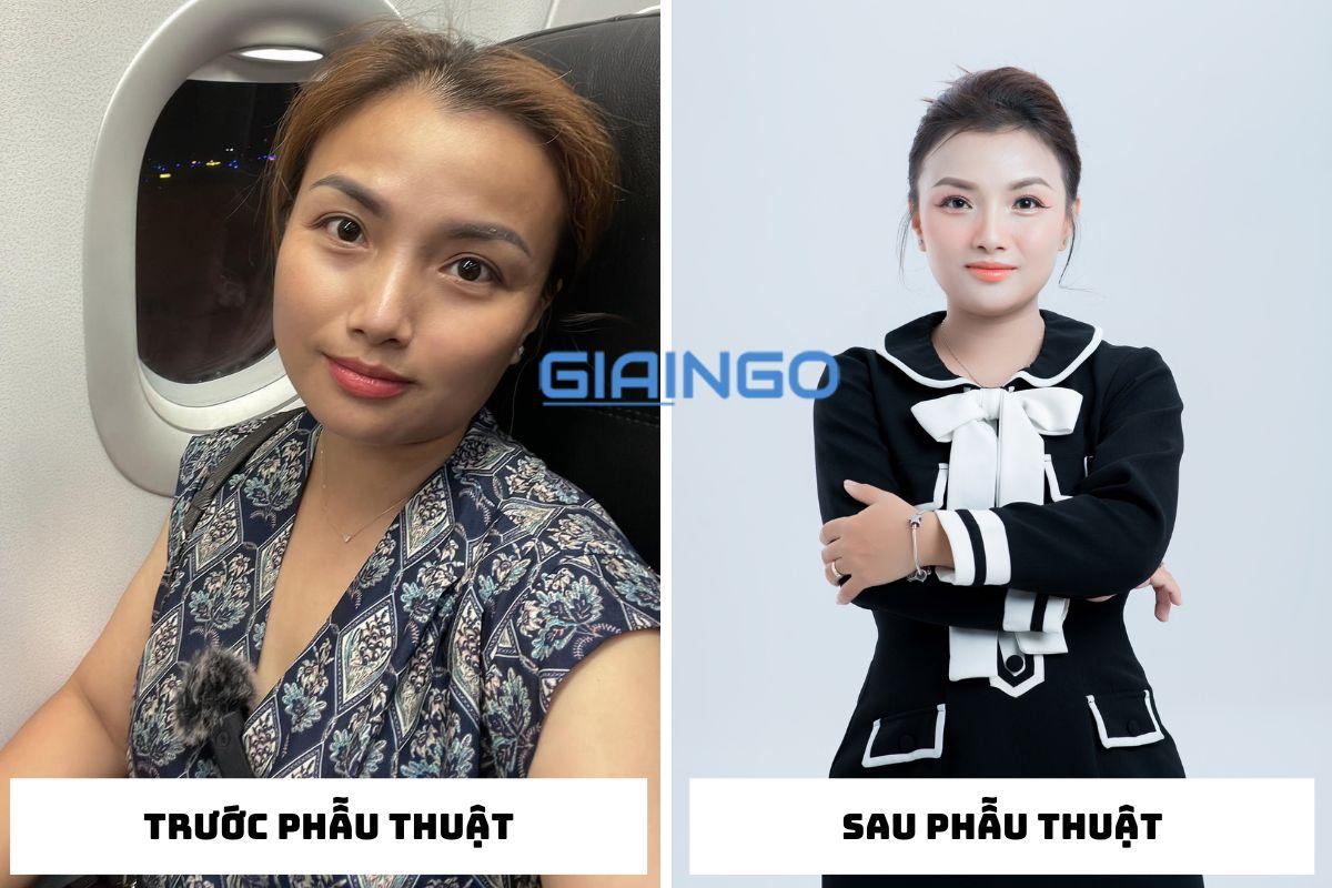 Quỳnh Trần JP phẫu thuật thẩm mỹ